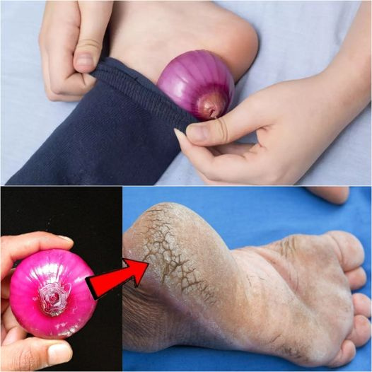 Say Goodbye to Cracked Heels with This Magical Onion Remedy