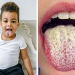 How to Treat a White Tongue and What Causes It in the Beginning…