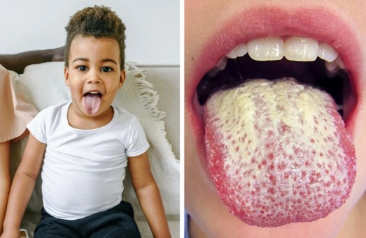 How to Treat a White Tongue and What Causes It in the Beginning…