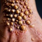 What to know about hand pimples