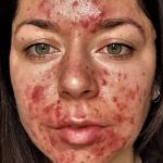 10 Methods for Treating Body Acne